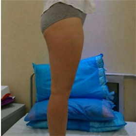 東方和諧馮斌做的大腿吸脂，給你們看看前后對比果圖片！