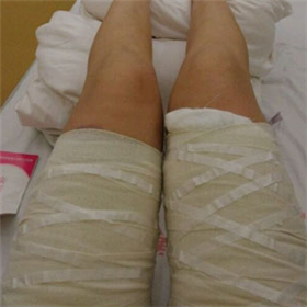 東方和諧馮斌做的大腿吸脂，給你們看看前后對比果圖片！