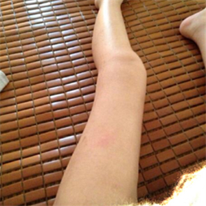 去東方和諧做了大腿抽脂，分享一下我的前后對比果圖片吧！