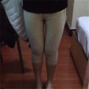 看看我大腿吸脂的前后對(duì)比果圖片吧，是東方和諧張準(zhǔn)做的