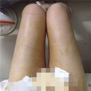 看看我大腿吸脂的前后對(duì)比果圖片吧，是東方和諧張準(zhǔn)做的