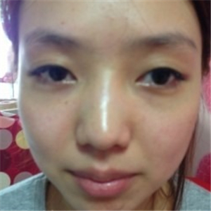 米揚麗格夏正義做雙眼皮果怎么樣？看看我的前后對比果圖片吧！
