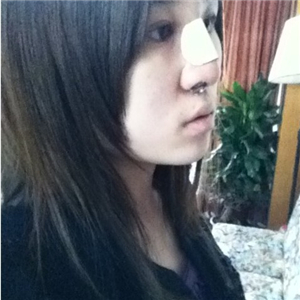 百*麗徐曉斐做的膨體假體隆鼻，給你們看看前后對比果圖片~