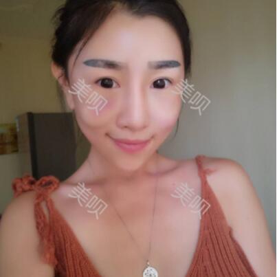 我自體脂肪面部填充后甩掉了干癟臉重回18歲了