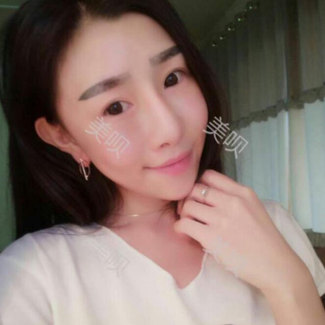 我自體脂肪面部填充后甩掉了干癟臉重回18歲了