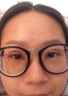 全切雙眼皮改良了我的內(nèi)雙腫泡眼，多虧了何賢清醫(yī)生