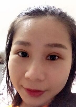 全切雙眼皮改良了我的內(nèi)雙腫泡眼，多虧了何賢清醫(yī)生