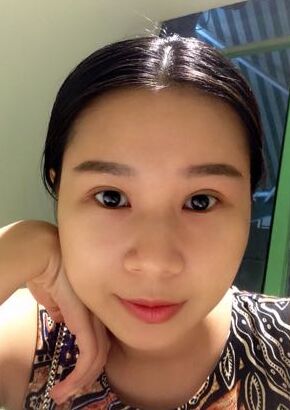 全切雙眼皮改良了我的內(nèi)雙腫泡眼，多虧了何賢清醫(yī)生