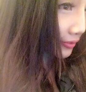 徐和林醫(yī)生給我注射玻尿酸隆鼻后顏值up