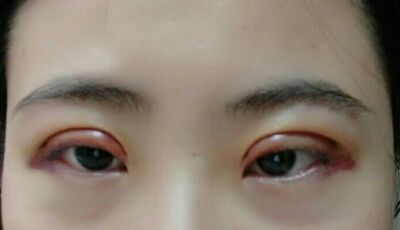 全切雙眼皮后眼形漂亮多了，安徽維多利亞徐和林做的喲