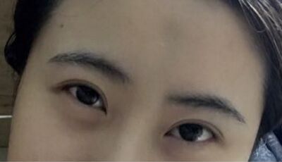 全切雙眼皮后眼形漂亮多了，安徽維多利亞徐和林做的喲