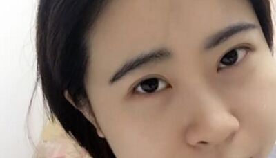 全切雙眼皮后眼形漂亮多了，安徽維多利亞徐和林做的喲