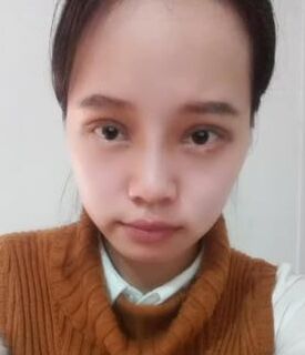 全切雙眼皮+去脂肪，終于擺脫小眼睛了