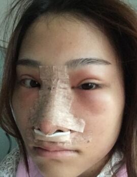 硅膠隆鼻還墊鼻尖了，甘泉涌做的果真的很好喲