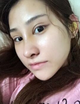 硅膠隆鼻還墊鼻尖了，甘泉涌做的果真的很好喲