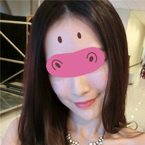 黃慶武醫(yī)生做的音波拉皮除皺手術分享，有很多前后對比果圖片哦~~~