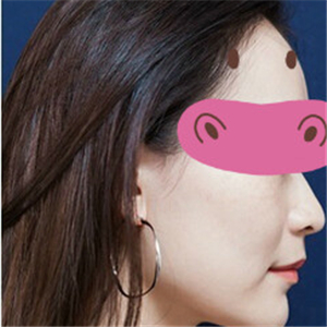 黃慶武醫(yī)生做的音波拉皮除皺手術分享，有很多前后對比果圖片哦~~~