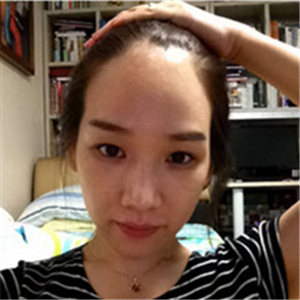 去年在格萊美做了頭發(fā)種植，看看前后對比和恢復(fù)果照片吧~~