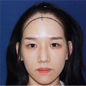 去年在格萊美做了頭發(fā)種植，看看前后對比和恢復(fù)果照片吧~~