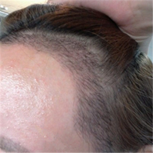 分享我頭發(fā)種植前后和恢復(fù)過程的圖片，是格萊美黃興勇做的哦~~~