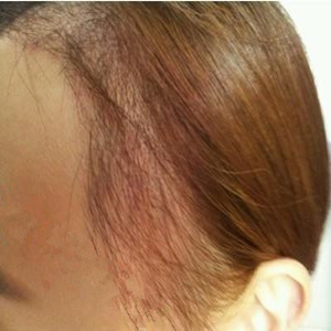 分享我頭發(fā)種植前后和恢復(fù)過程的圖片，是格萊美黃興勇做的哦~~~