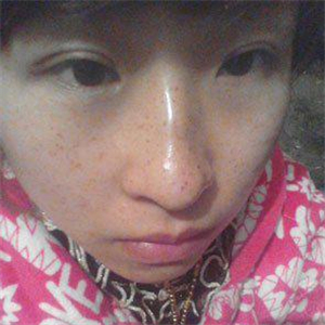 去格萊美做了激光去雀斑，有恢復(fù)前后的對比照片哦，還不錯~~