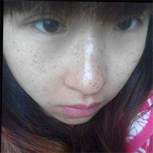 去格萊美做了激光去雀斑，有恢復(fù)前后的對比照片哦，還不錯~~