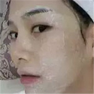 做了激光去雀斑前后對比照片分享，黃俊俊的技術(shù)很好哦！