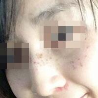 花費(fèi)4000元做了激光祛斑，終于把雀斑消滅了555555