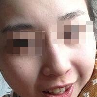 花費(fèi)4000元做了激光祛斑，終于把雀斑消滅了555555