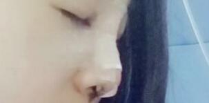 將自己隆鼻恢復過程分享給大家,希望對有需求的MM有幫助