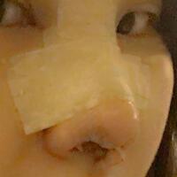 假體隆鼻，耳軟骨墊鼻尖，鼻頭縮小等隆鼻整形分享