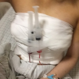 去年10月做的假體隆胸手術，大家來看看怎么樣