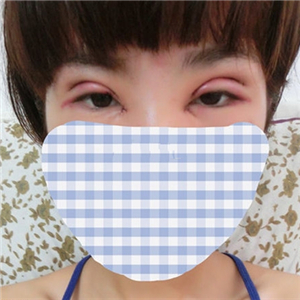 做park法雙眼皮手術(shù)一個(gè)月了，果很好，有恢復(fù)過(guò)程照片哦~~