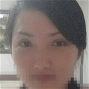 楊亞益醫(yī)生做的雙眼皮+開(kāi)眼角，果不錯(cuò)，看看我的恢復(fù)照片~~~