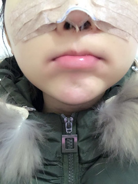 去年做的隆鼻整形手術(shù)，恢復的差不多了