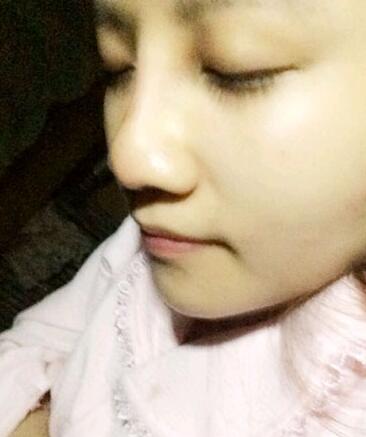 假體隆鼻15天后恢復(fù)果 杭州時光做的~