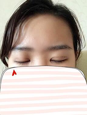 納米x雕雙眼皮15天了~ 我恢復(fù)的算快嗎