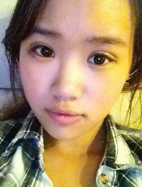 納米x雕雙眼皮15天了~ 我恢復(fù)的算快嗎