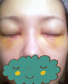 杭州時光激光去眼袋1個月了