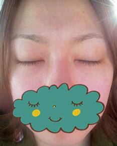 杭州時光激光去眼袋1個月了