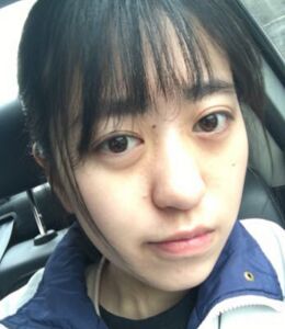 激光點痣不留坑不留疤，果棒棒噠