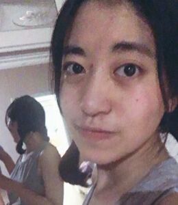 激光點痣不留坑不留疤，果棒棒噠