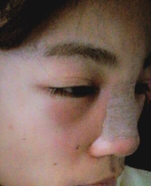 硅膠假體隆鼻后側(cè)面看起來超**的