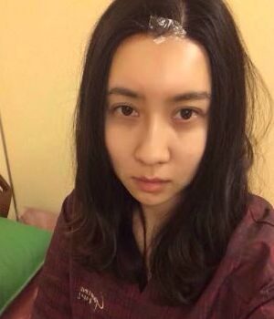 自體脂肪全臉填充后整個面部都很飽滿喲