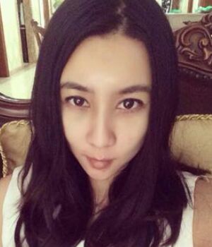 自體脂肪全臉填充后整個面部都很飽滿喲