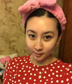 自體脂肪全臉填充后整個面部都很飽滿喲