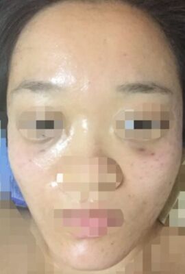 打了水光補水皮膚嫩滑有光澤了