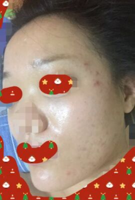打了水光補水皮膚嫩滑有光澤了