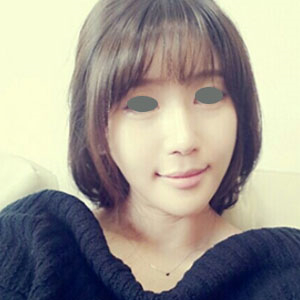 下頜角整形手術(shù)三個多月了，分享下我的恢復(fù)前后對比果圖片吧~